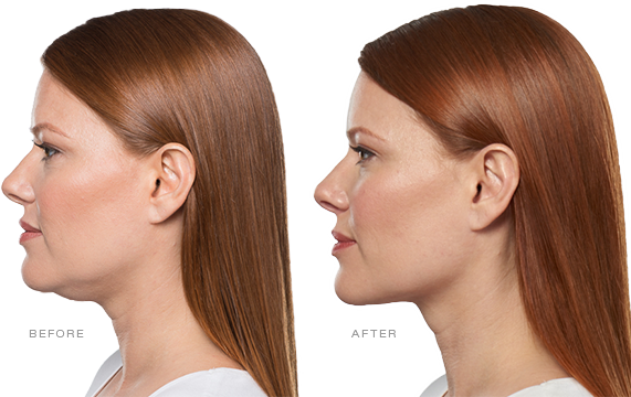 kybella before and after