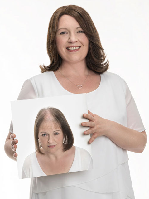 Microlines-Belinda hair loss model