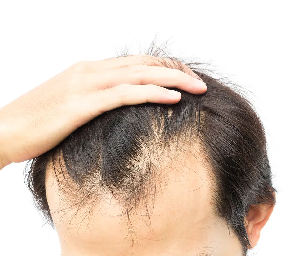 Hair-loss-kerastase